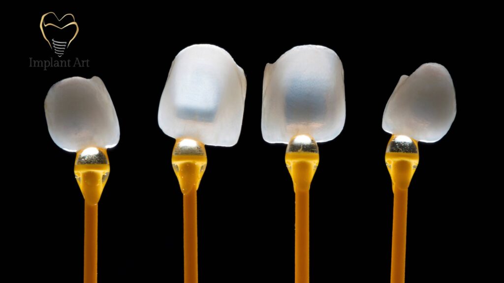 Veneers