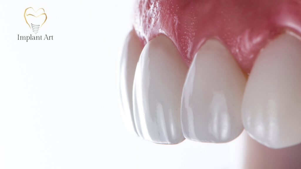 Common Misconceptions about No Prep Veneers