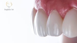 Common Misconceptions about No Prep Veneers