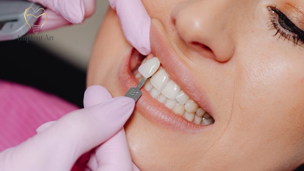 no-prep-veneers