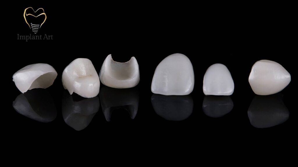 No-Prep Veneers