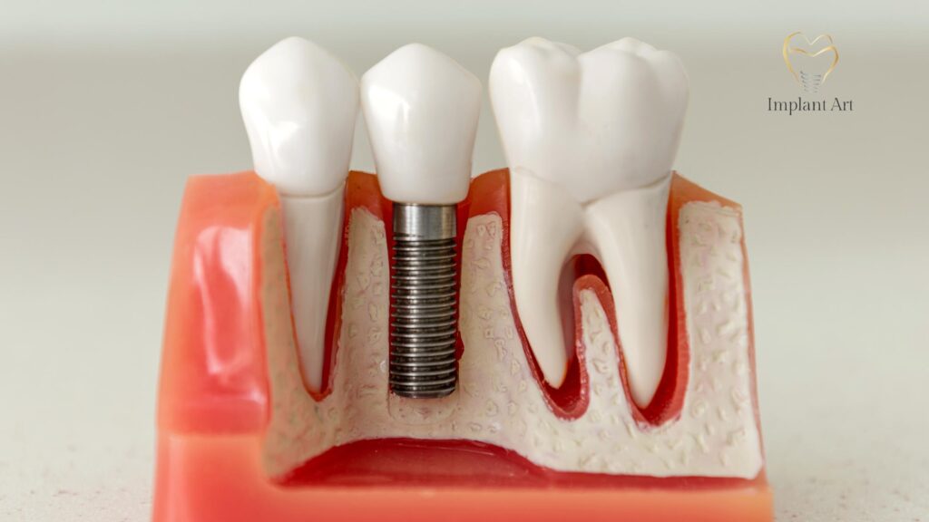Dental Implants Brisbane
