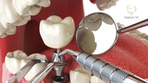 Teeth Implants Brisbane