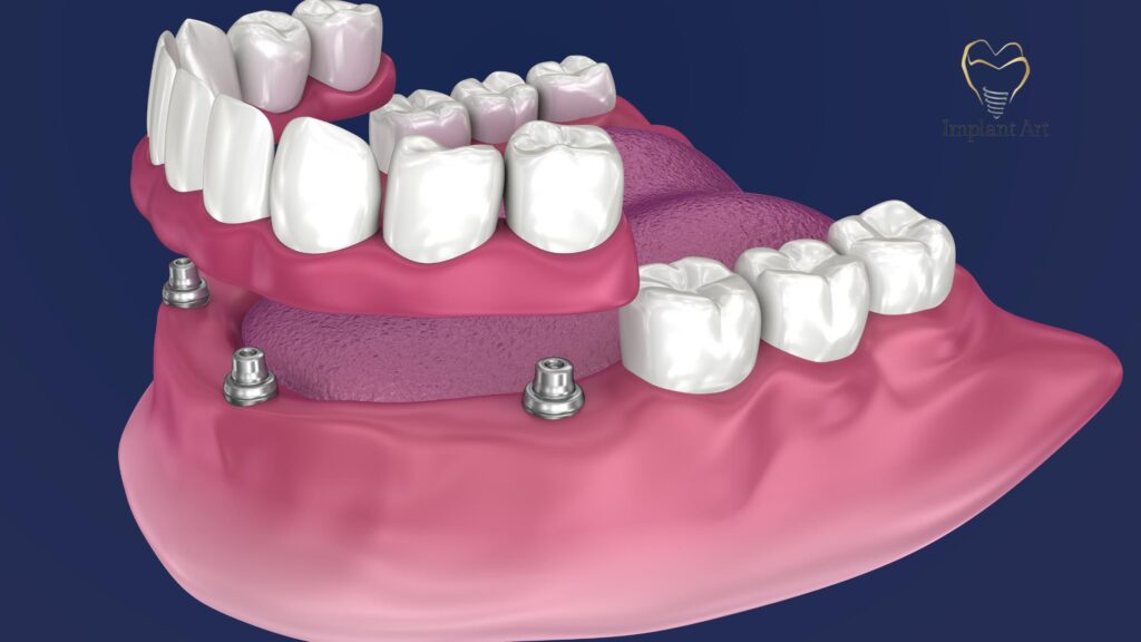 Dental Implant All on 4