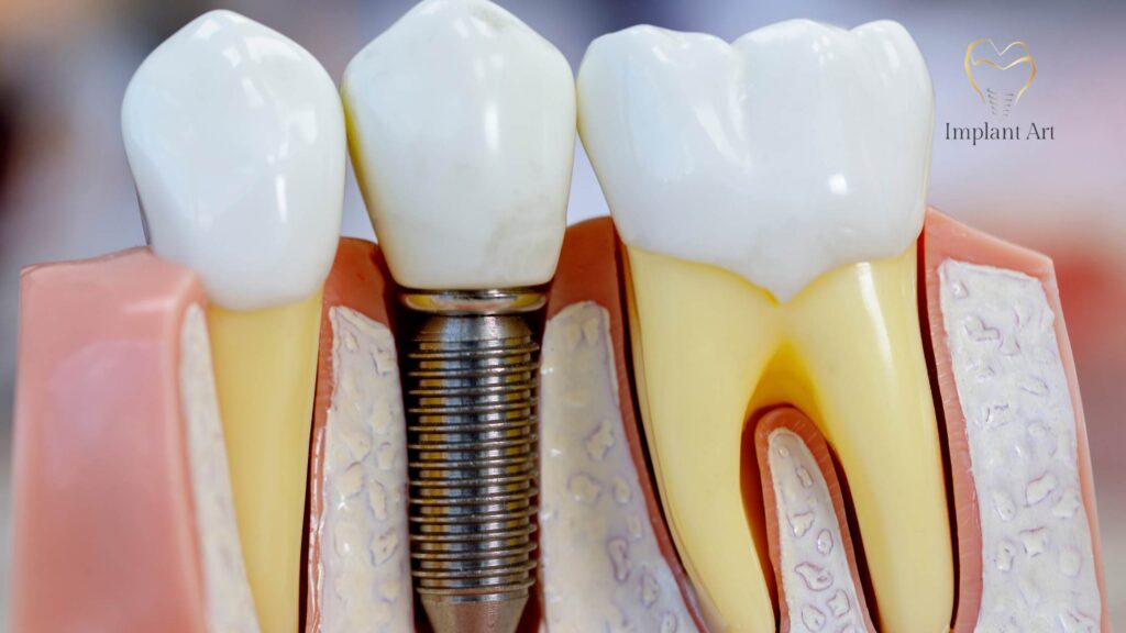 Teeth Implants Brisbane