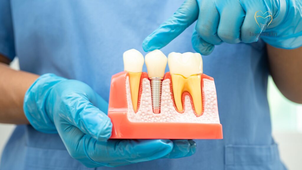 Traditional Dental Implants Brisbane