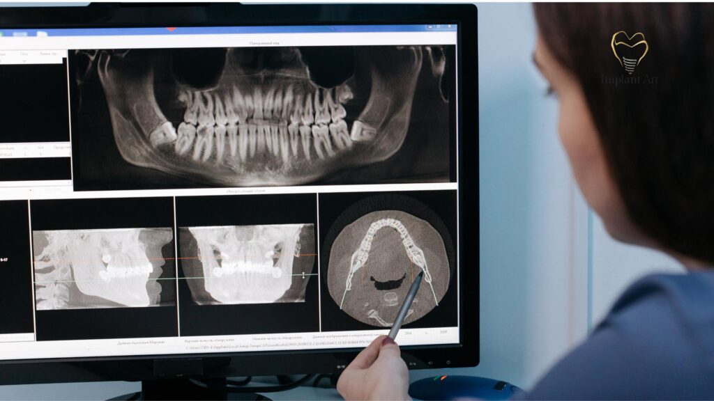 Dental Implants Brisbane