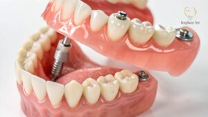 Implant-Supported Dentures