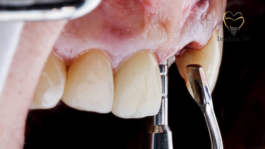 Dental Bone Graft