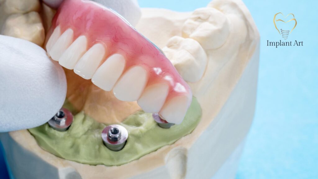 All-on-4 Dental Implants