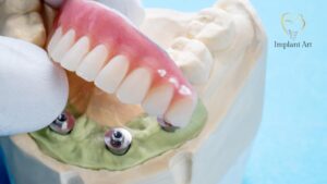 All-on-4 Dental Implants